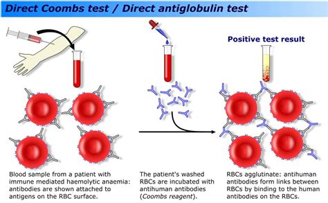 coombs test blood bottle|why does coombs test work.